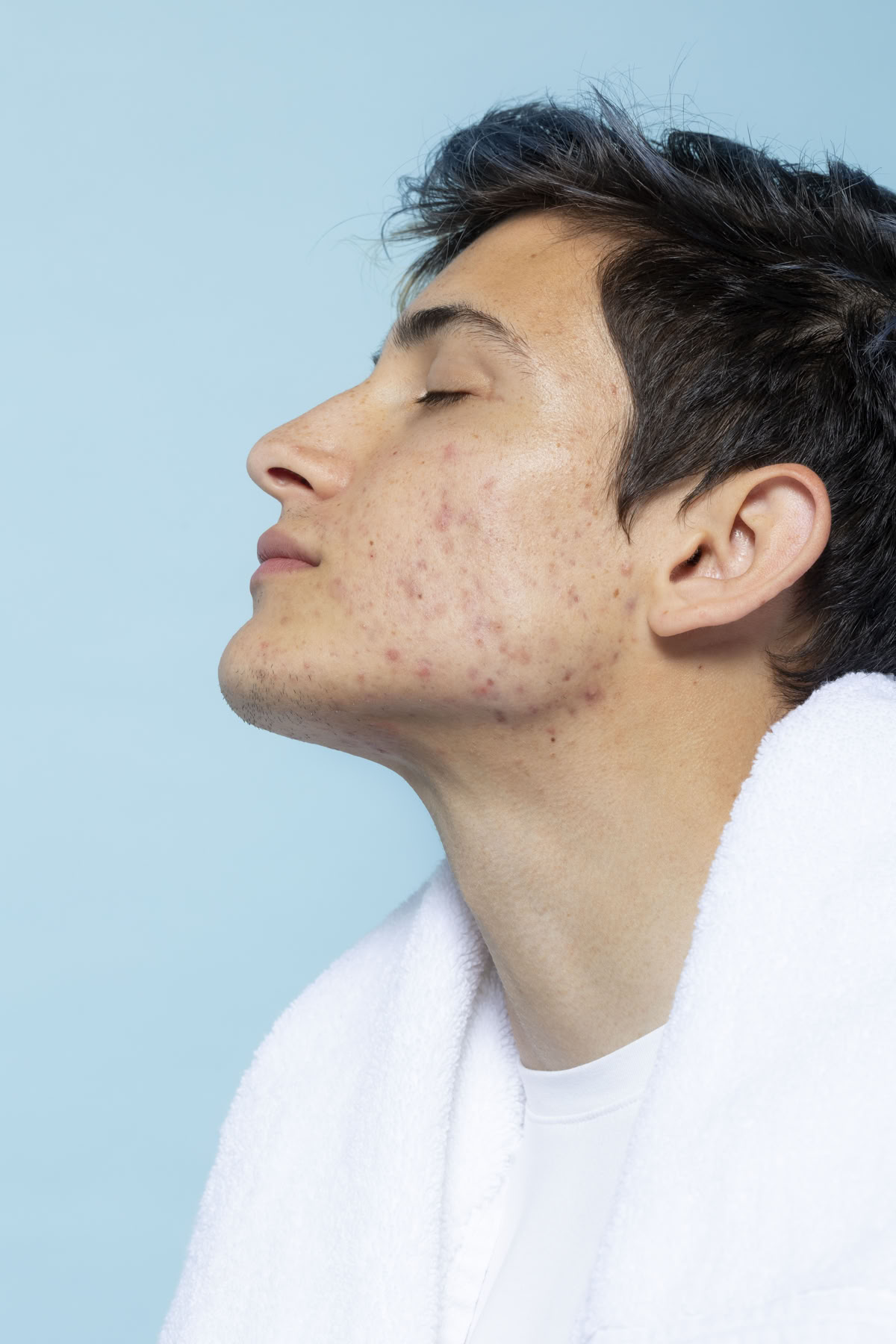 pigmentaton acne